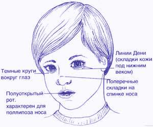 Классическое лицо ребенка-аллергика